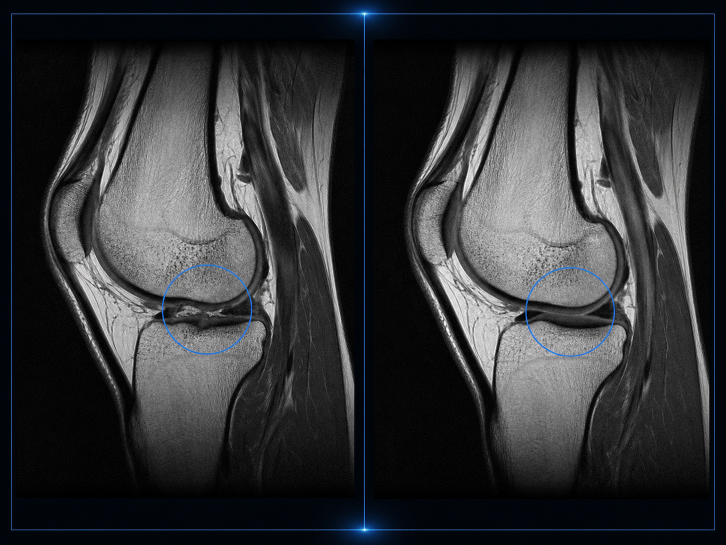 무릎관절염 MRI 치료 전후